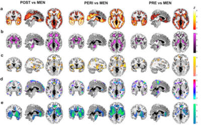 MRI slice overlays displaying biomarker differences between each MT group and males. (Credit: &quot;Menopause impacts human brain structure, connectivity, energy metabolism, and amyloid-beta deposition&quot; /Sci Rep. 2021) 